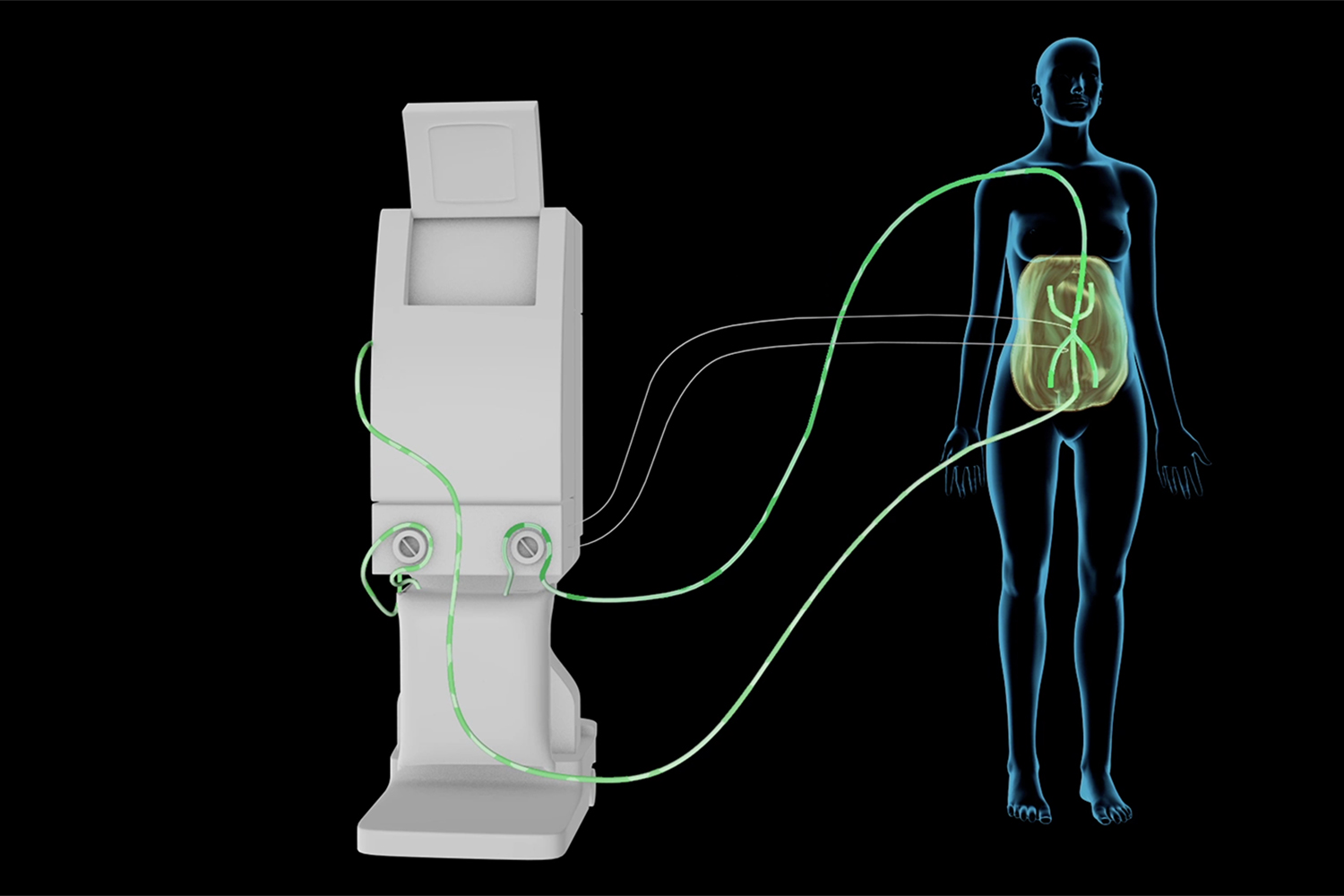 HIPEC Procedure